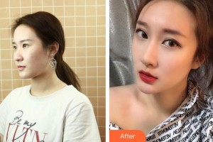 臺州博仕醫(yī)療整形美容醫(yī)院郭堅整形價格表附鼻部綜合案例展示