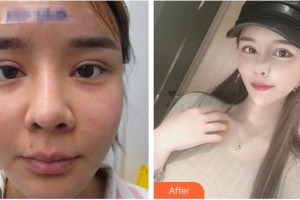 臺州博雅美惠醫(yī)療美容整形醫(yī)院張人波整形價格表附肋軟骨隆鼻案例展示