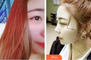 臺州維多利亞整形美容醫(yī)院王慶春整形價格表附超聲波潔牙案例展示