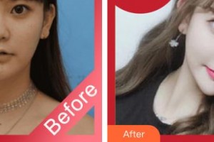 臺(tái)州市博愛(ài)醫(yī)院整形美容科方芳整形價(jià)格表附鼻部綜合案例展示