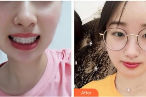 臺(tái)州維多利亞整形美容醫(yī)院于文學(xué)整形價(jià)格表附牙齒隱形矯正案例展示