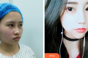 臺(tái)州維多利亞整形美容醫(yī)院陸新整形價(jià)格表附埋線提升案例展示