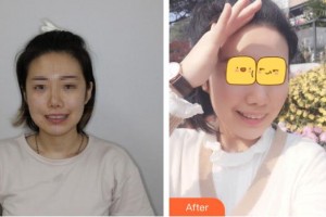 臺(tái)州維多利亞整形美容醫(yī)院藍(lán)海慧整形價(jià)格表附牙齒隱形矯正案例展示