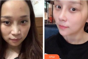 臺(tái)州市博愛(ài)醫(yī)院整形美容科孫菊妹整形價(jià)格表附肋軟骨隆鼻案例展示