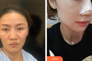 臺(tái)州醫(yī)院燒傷整形科鄭金滿整形價(jià)格表附鼻部修復(fù)案例展示