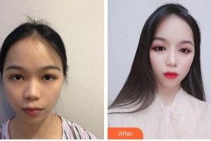 臺(tái)州骨傷醫(yī)院整形美容科項(xiàng)攀整形價(jià)格表附鼻部綜合案例展示