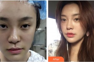 臺(tái)州市立醫(yī)院燒傷整形外科魯繼增整形價(jià)格表附埋線提升案例展示