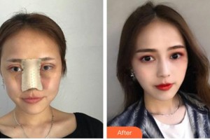 臺(tái)州愛(ài)美美萊醫(yī)療美容門診部王俊整形價(jià)格表附鼻部綜合案例展示