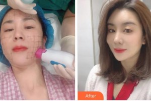 臺(tái)州博雅美惠醫(yī)療美容整形醫(yī)院朱剛強(qiáng)整形價(jià)格表附熱瑪吉案例展示