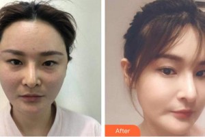 臺(tái)州博雅美惠醫(yī)療美容整形醫(yī)院李影影整形價(jià)格表附埋線提升案例展示