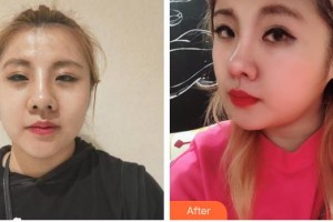 臺(tái)州愛(ài)美美萊醫(yī)療美容門診部吳應(yīng)凱整形價(jià)格表附熱瑪吉案例展示