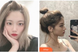 臺(tái)州仁登醫(yī)療美容門診部林峰整形價(jià)格表附鼻部綜合案例展示