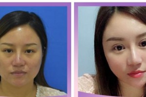 臺(tái)州恩璨醫(yī)療美容門診部汪堡壘整形價(jià)格表附激光去眼袋案例展示