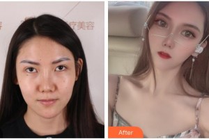 臺(tái)州韓爾口腔門診部郟海江整形價(jià)格表附切開雙眼皮案例展示