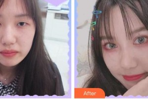 臺(tái)州國(guó)際眼科醫(yī)院黃小明整形價(jià)格表附開內(nèi)眼角案例展示