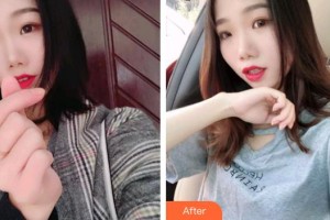 臺(tái)州牙科醫(yī)院顏德權(quán)整形價(jià)格表附牙齒隱形矯正案例展示