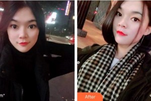 臺(tái)州拜博口腔醫(yī)院丁大偉整形價(jià)格表附牙齒隱形矯正案例展示