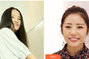 臺(tái)州拜博口腔醫(yī)院王越整形價(jià)格表附牙齒隱形矯正案例展示