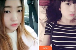 臺州貝雅口腔醫(yī)院王文敏整形價格表附金屬托槽矯正案例展示