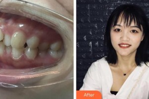臺州貝雅口腔醫(yī)院徐仙龍整形價格表附金屬托槽矯正案例展示