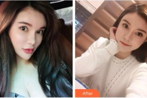 臺州貝雅口腔醫(yī)院史佩強(qiáng)整形價格表附超聲波潔牙案例展示