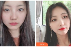 臺州愛爾眼科醫(yī)院解林根整形價格表附眼部綜合案例展示