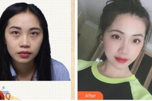 臺州國際眼科醫(yī)院王時力整形價格表附激光去眼袋案例展示