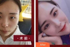 臺州國際眼科醫(yī)院張佳整形價格表附眼部綜合案例展示