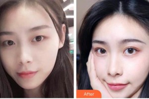 臺州國際眼科醫(yī)院王一博整形價格表附切開雙眼皮案例展示