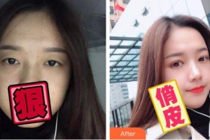 臺州國際眼科醫(yī)院姜儉整形價格表附切開雙眼皮案例展示