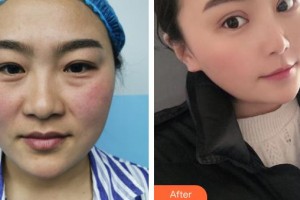 臺州國際眼科醫(yī)院丁陽整形價格表附外切祛眼袋案例展示