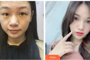 臺州國際眼科醫(yī)院胡劼整形價格表附切開雙眼皮案例展示