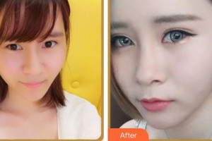 臺州國際眼科醫(yī)院張美君整形價格表附眼部綜合案例展示