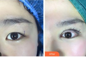 臺州國際眼科醫(yī)院沈咲整形價格表附眼部綜合案例展示