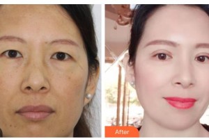 臺州國際眼科醫(yī)院王肖整形價格表附切開雙眼皮案例展示