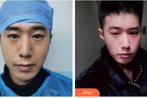 臺州國際眼科醫(yī)院王毓琴整形價格表附眼部綜合案例展示