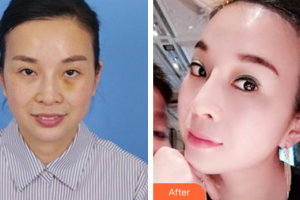 深圳美芮（原雅唯）醫(yī)療美容門診部唐建軍整形價格表附埋線提升案例展示