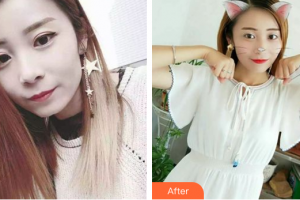 深圳美芮（原雅唯）醫(yī)療美容門診部諶貽進整形價格表附冷光美白案例展示