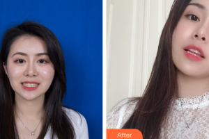 深圳美芮（原雅唯）醫(yī)療美容門診部羅衛(wèi)釵整形價格表附隱形牙齒矯正案例展示