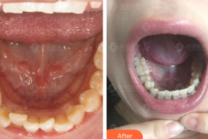 深圳美芮（原雅唯）醫(yī)療美容門診部彭翼整形價格表附牙齒矯正案例展示