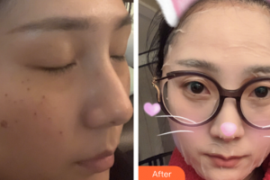 深圳麗港麗格醫(yī)療美容門診部向曉舟整形價格表附超激光美膚+祛斑針案例展示