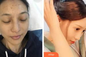 深圳博愛醫(yī)院整形美容中心常振河整形價格表附光子嫩膚案例展示