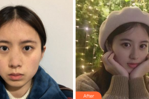 深圳芝華醫(yī)療美容門診部高順福整形價格表附鼻部手術(shù)案例展示