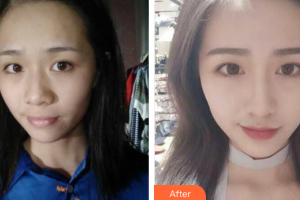 深圳韓美爾醫(yī)療美容門診部高羅鏞整形價格表附鼻部手術(shù)案例展示