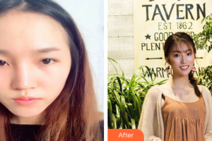 深圳銘醫(yī)醫(yī)療美容醫(yī)院張青松整形價格表附鼻部手術(shù)案例展示