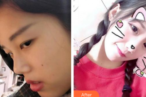 深圳悅己醫(yī)療美容醫(yī)院劉學(xué)鋒整形價格表附鼻部手術(shù)案例展示