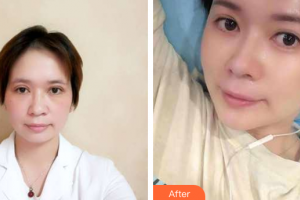 深圳銘醫(yī)醫(yī)療美容醫(yī)院高旭整形價格表附切開雙眼皮案例展示