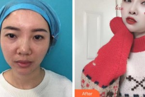 臺州國際眼科醫(yī)院馬慧香整形價格表附眼部修復(fù)案例展示