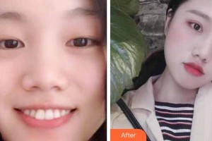 臺州國際眼科醫(yī)院李瑾整形價格表附切開雙眼皮案例展示