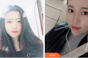 臺州國際眼科醫(yī)院林冰整形價格表附切開雙眼皮案例展示